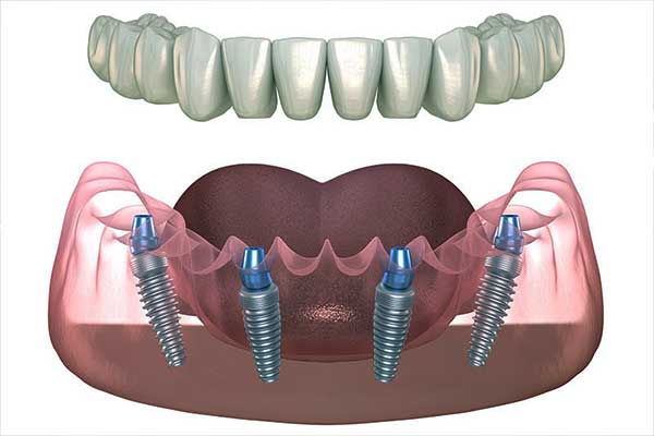 Impianto Dentale per Parodontite: Una Soluzione Moderna e Efficace