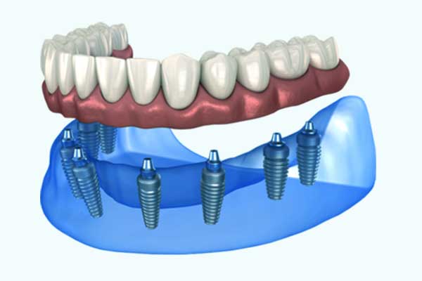 Impianto Dentale Perno: Tutto Quello che Devi Sapere