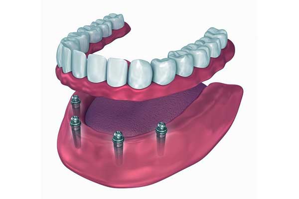 impianto dentale provvisorio quanto dura? Scopri Tutti i Dettagli!