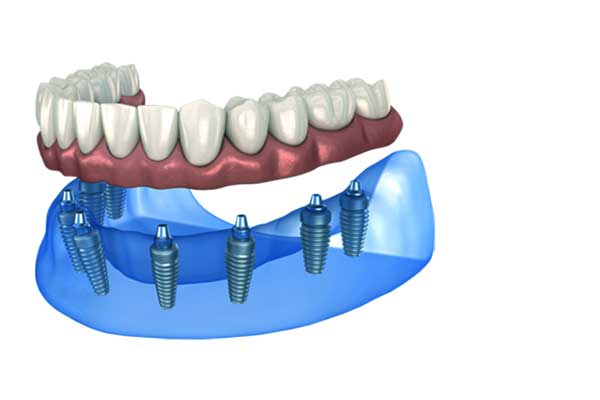 Impianto Dentale Intera Arcata: La Soluzione Definitiva per un Sorriso Perfetto