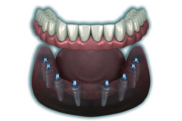 Impianto Dentale Avvitato: Tutto Quello Che Devi Sapere