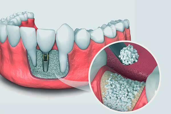 Impianto Dentale in Titanio: Una Soluzione Duratura e Biocompatibile