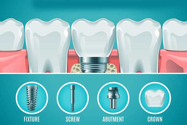 Impianto Dentale Rischi e Come Prevenirli