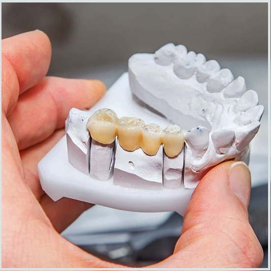 Impianto Dentale Protesi: La Guida Completa per un Sorriso Perfetto