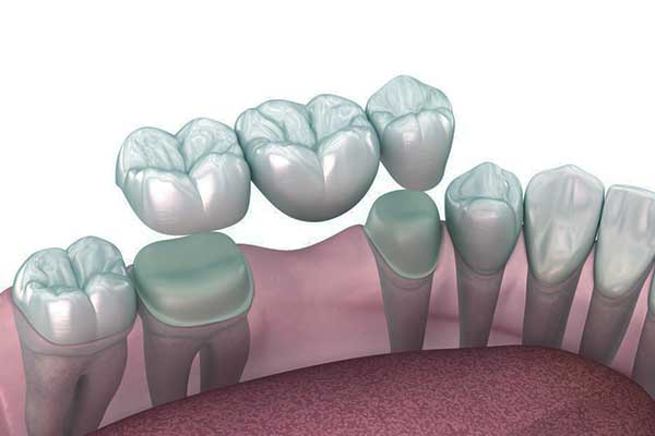 Impianto Dentale ASL: Guida Completa su Vantaggi, Costi e Procedure