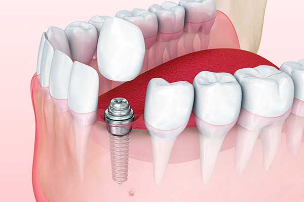 Impianto Dentale con Gengiva Finta: 4 Benefici da Conoscere