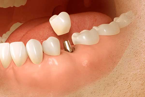 Preventivo Impianto Dentale: Guida Completa ai Costi, Tecniche e Consigli