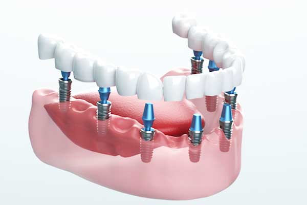 Impianto Dentale Scoperto: Vantaggi, Rischi e Costi :Guida Completa 2024