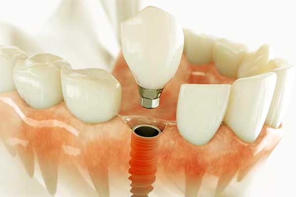 impianto dentale rotto: Soluzioni, Tecniche e Costi