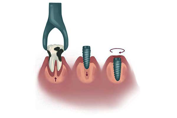 Estrazione e Impianto Dentale: Tutto Quello che Devi Sapere