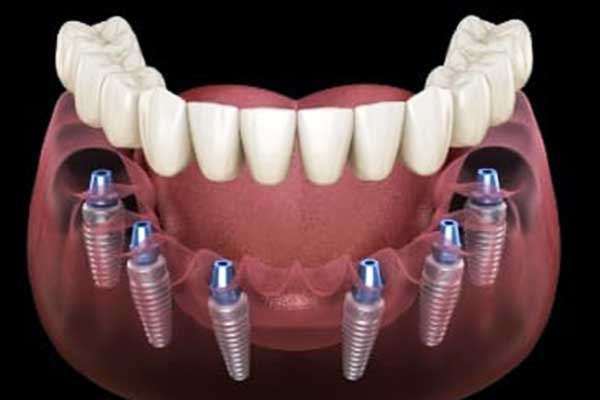 ricostruzione osso per impianto dentale: La Guida Completa per un Sorriso Perfetto