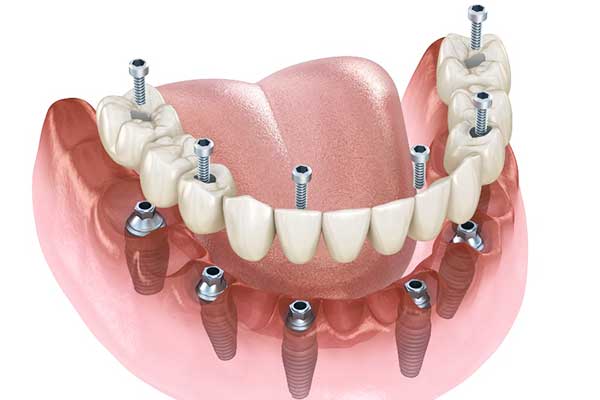 Impianto Dentale per 4 Denti: La Guida Completa