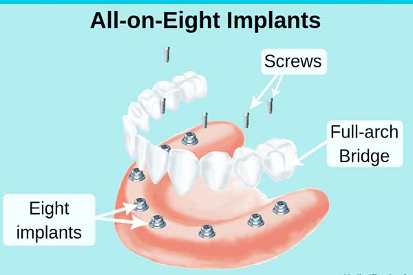 Impianto Dentale 25: Una Soluzione a Lungo Termine per il Tuo Sorriso