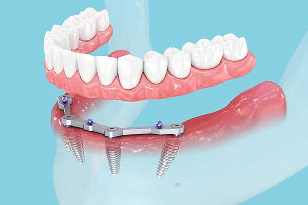 Impianto Dentale che si Svita: Tutto quello che Devi Sapere per Risolvere il Problema