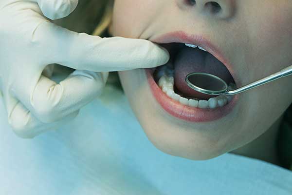 Impianto Dentale Ponte: Quale Soluzione è Migliore per Te?