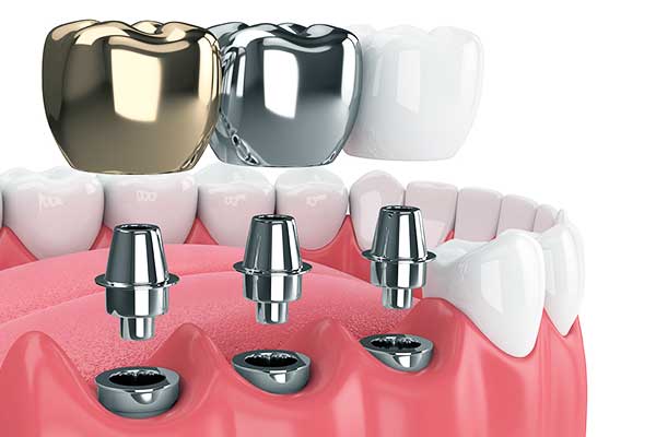 Impianto Dentale Incisivi Inferiori: La Soluzione Perfetta per il Tuo Sorriso