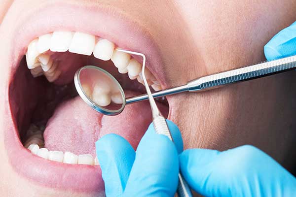 Estrazione e Impianto Dentale nella Stessa Seduta: La Guida Completa