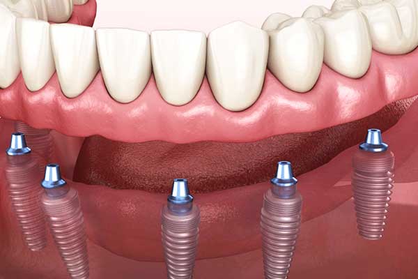 Tutto ciò che devi sapere sull’impianto dentale superiore: Guida completa e dettagliata