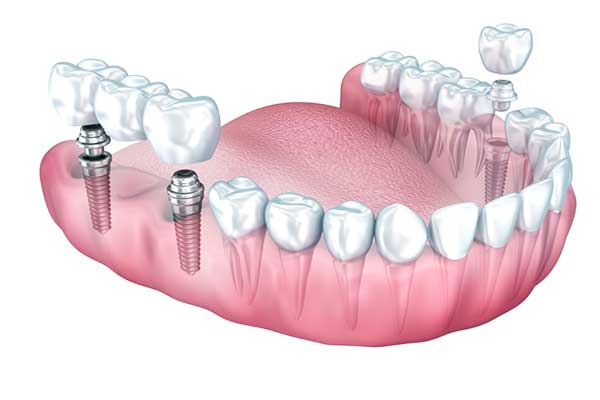 estrazione impianto dentale: Tutto Quello che Devi Sapere