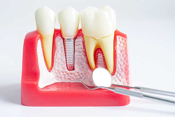 Impianto Dentale SSN: 5 Modi per Risparmiare e Ottenere Cure Gratuite