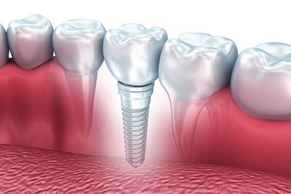 impianto dentale tempi guarigione e Tutti gli Aspetti che Devi Conoscere