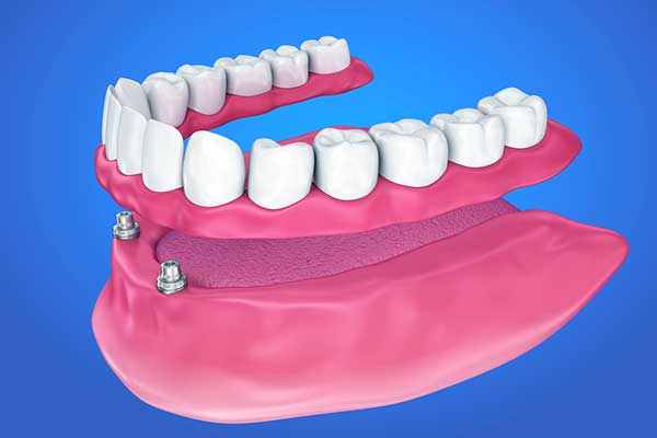 impianto dentale titanio rischi: Tutti i Rischi da Conoscere