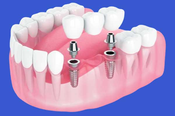 impianto dentale tutte le fasi: Una Guida Completa