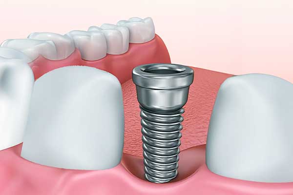 Impianto Dentale Vite di Guarigione: Tutto Quello che Devi Sapere per una Scelta Consapevole