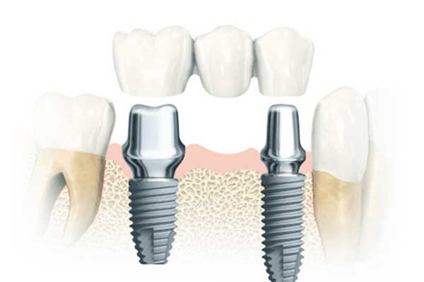 Impianto Dentale Vite: La Guida Completa per Scegliere la Migliore Soluzione