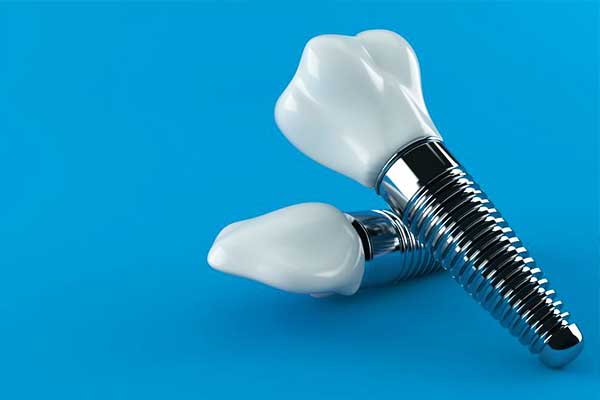 Impianto Dentale Zirconio Ceramica: Scopri Tutto Quello che Devi Sapere