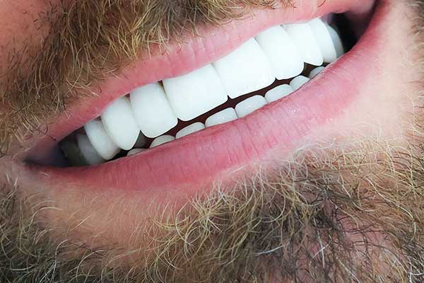 Impianto Dentale 4 Elementi: Una Guida Completa per il Tuo Sorriso Perfetto