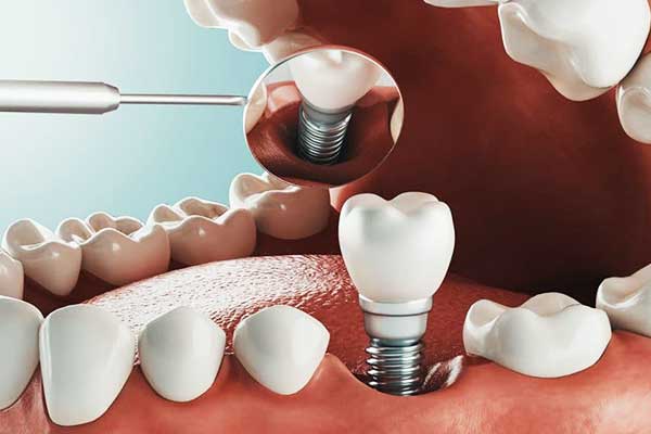 impianto dentale straumann prezzo: Tutto Quello che Devi Sapere