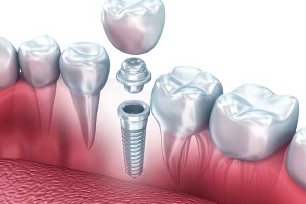 l impianto dentale è doloroso? Scopri tutti gli aspetti e cosa aspettarti