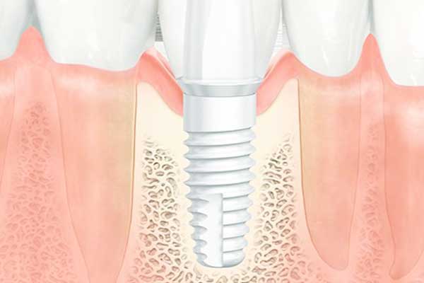 L’l impianto dentale si muove: Cause, Soluzioni e Prevenzione