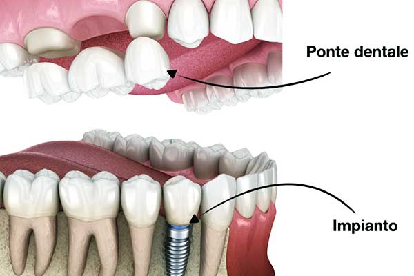 Meglio un Ponte o un Impianto Dentale: Guida Completa per Scegliere la Soluzione Giusta