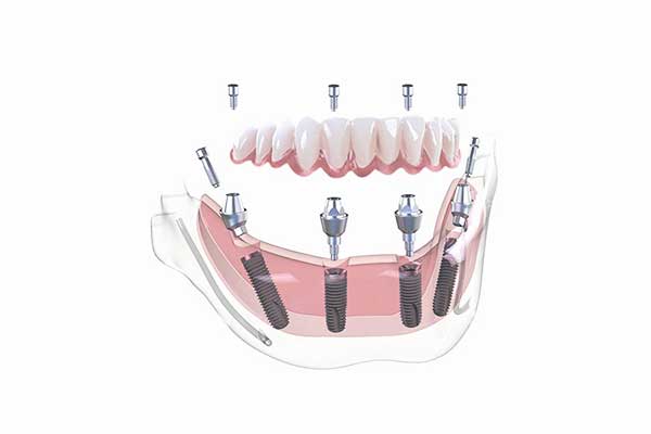 Metasalute Impianto Dentale: Una Guida Completa per i Lavoratori e le Famiglie