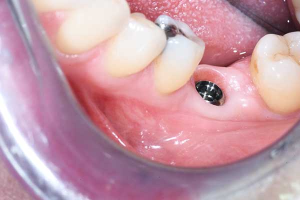 Mettere Impianto Dentale: Guida Completa e Tutto ciò che Devi Sapere