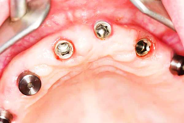 cuáles son los tres tipos de implantes dentales en Turquía: Todo lo que Necesitas Saber