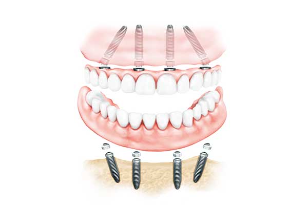 parodontite e impianto dentale : 5 Tecniche Moderne per il Successo