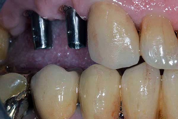 Ponte o Impianto Dentale: Quale Scegliere? Una Guida Completa