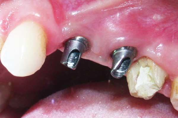 ponte o impianto dentale costi: Qual è il Migliore? Scopri i Costi e le Differenze