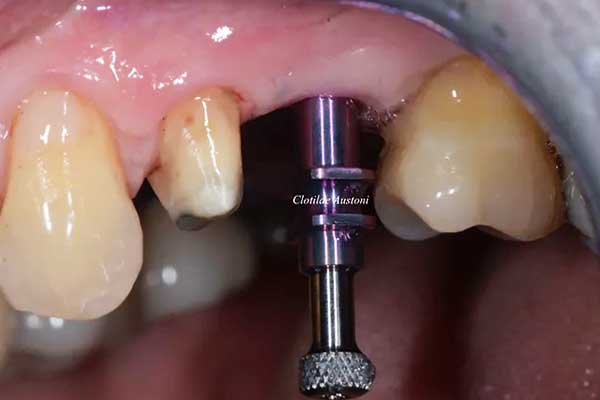 Tipos de Implantes Dentales y Precios en Turquía: Todo lo que Necesitas Saber en 2024