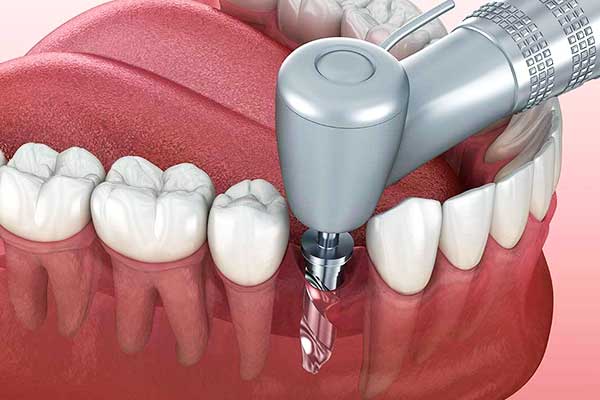 Guida completa agli impianto dentale senza vite di guarigione: Tecniche, vantaggi e costi