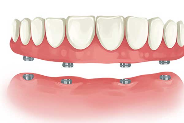 Impianto Dentale Inferiore: La Soluzione Completa per il Sorriso Perfetto