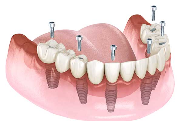 Impianto Dentale Titanio: La Guida Completa per Scegliere la Soluzione Migliore per il Tuo Sorriso