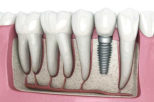 Impianto Dentale con Innesto Osseo: Tutto Quello che Devi Sapere