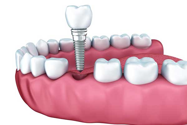 Tutto ciò che devi sapere sull’impianto dentale al titanio: vantaggi, tecniche e costi