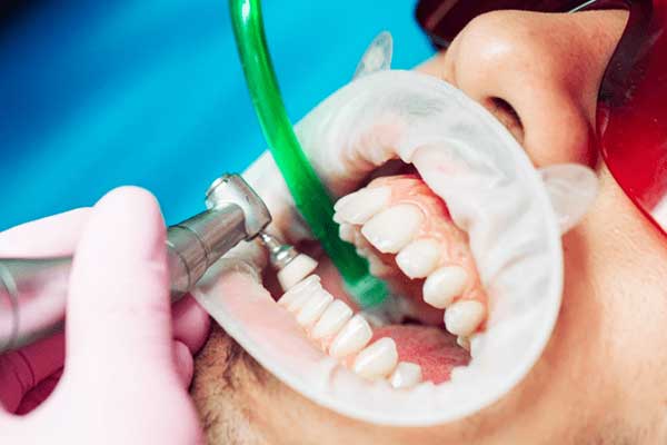 impianto dentale tempi di guarigione Complete