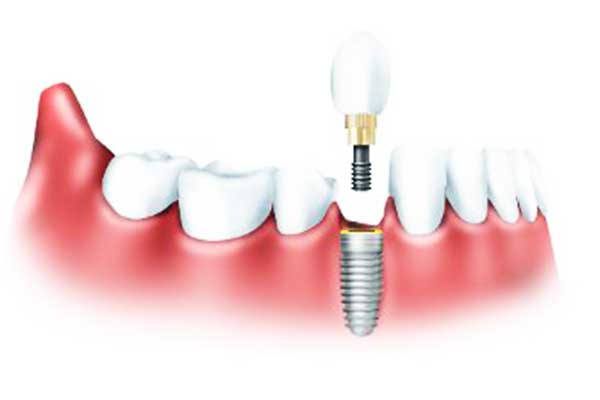 implantes dentales precios económicos en Turquía: Los Mejores Precios Económicos en 2024