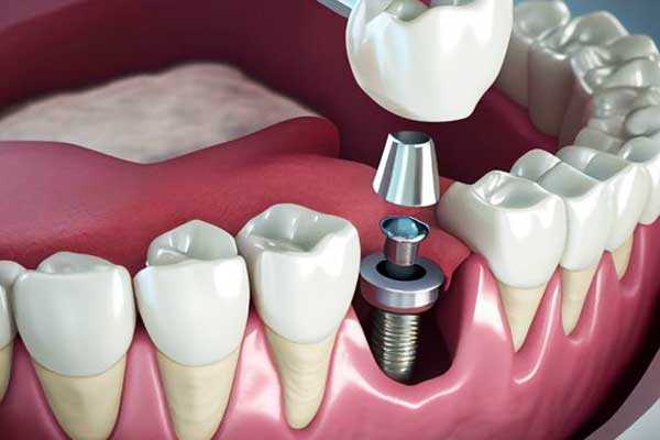 ¿Cuánto Cuestan los Implantes Dentales en Turquía? Guía Completa para el 2024